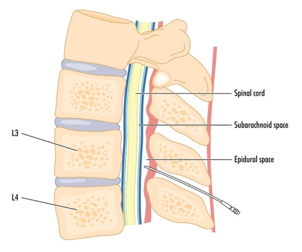 Epidural Steroid Injection Dr. Mikiko Murakami