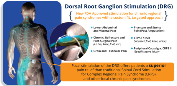 Dorsal Root Ganglion Stimulator Dr Mikiko Murakami